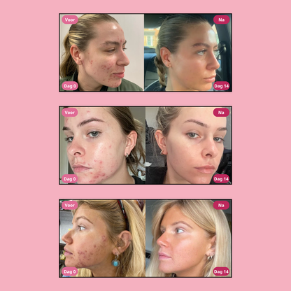 Moika Acne Verwijderaar - Snelle acne aanpak