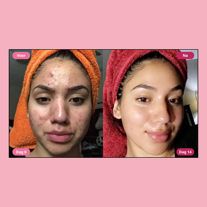 Moika Acne Verwijderaar - Snelle acne aanpak