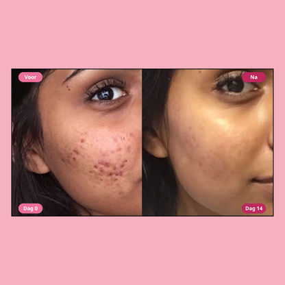 Moika Acne Verwijderaar - Snelle acne aanpak